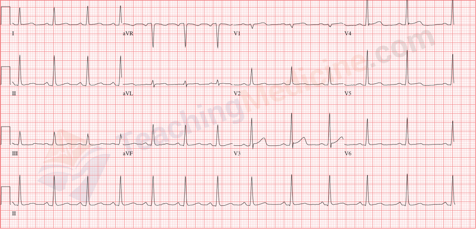 normal-sinus-rhythm